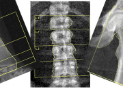 ضرورت آزمایش سنجش تراکم استخوان برای همه افراد بالای 65 سال