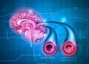 پیش‌بینی خطر سکته مغزی با اندازه و شکل عروق خونی مغز