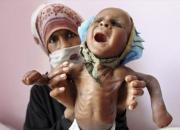 وضعیت دردناک کودکان یمنی+ فیلم