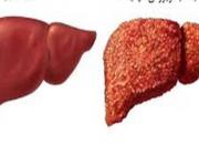 چطور هپاتیت «C» را درمان کنیم؟