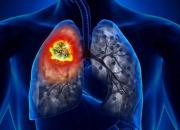 اینفوگرافیک/ مهمترین نشانه‌های سرطان ریه