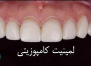 لمینت دندان و مراحل نصب آن روی دندان